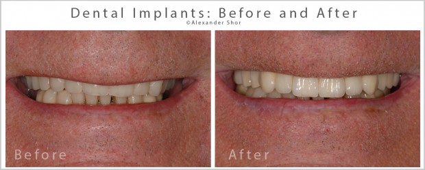 Full Mouth Dental Implants Before and After